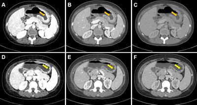 Predicting Response to Systemic Chemotherapy for Advanced Gastric Cancer Using Pre-Treatment Dual-Energy CT Radiomics: A Pilot Study